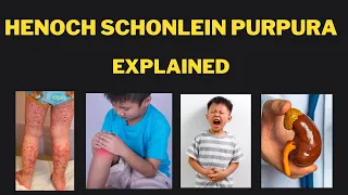 Henoch Schonlein Purpura IgA vasculitis Pathophysiology, presentations, investigations and treatment