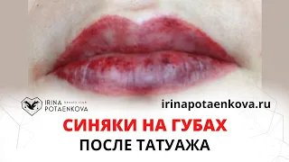 Синяки на губах после татуажа? Почему?