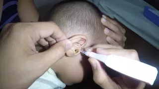 3 Year Old Boy's Earwax Removal with Hydrogen Peroxide Application