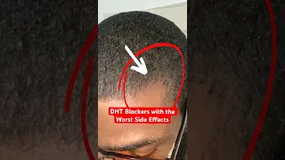 DHT Blockers! Watch out for these side effects. | Brotherly Hair Loss Tips (3/30)