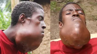My Giant Facial Tumor Is Killing Me : THIS VIDEO WILL MAKE YOU CRY