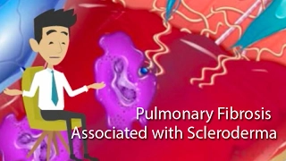 Relationship between Scleroderma and Pulmonary Fibrosis