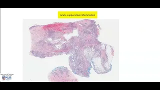 Skin Carbuncle Microscopy - Talking slide