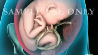 Breech Birth Position - 3D Rotation