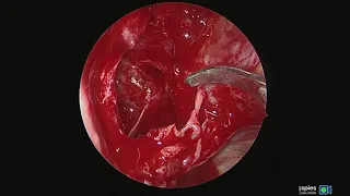 Orbital apex tumor excision