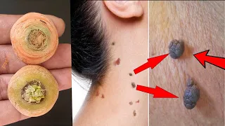 Remove skin tags in 1 night / Magical Remedies For Skin Tag Removal/  How to remove skin tags