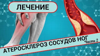 КАК ЛЕЧИТЬ АТЕРОСКЛЕРОЗ СОСУДОВ НОГ? (Часть 2)