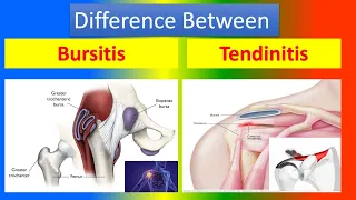 Difference Between Bursitis and Tendinitis