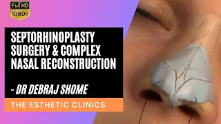 Septorhinoplasty Surgery & Complex Nasal Reconstruction for the Correction of Crooked Nose in India