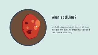 Cellulitis: Causes, Symptoms, Diagnosis, and Treatment | Merck Manual Consumer Version Quick Facts