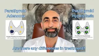 Parathyroid adenoma vs parathyroid hyperplasia | Is there a difference in treatment?