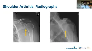 Advanced Treatment for Shoulder Arthritis – Robert Boykin, MD
