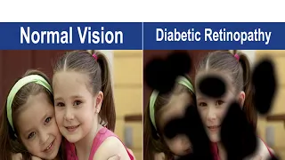 Diabetic retinopathy Unresolved mysteries