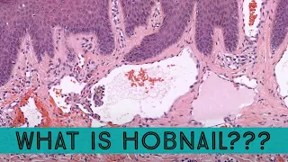 What is hobnail??? Vascular tumor basics (pathology dermpath dermatology dermatopathology)