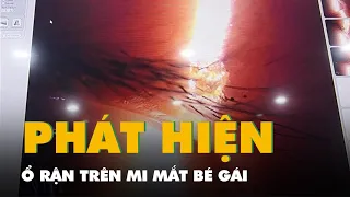 Phát hiện ổ rận trên mi mắt bé gái