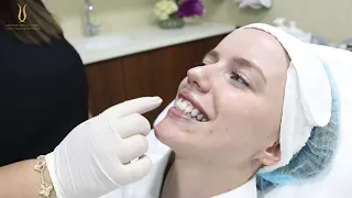 Gummy Smile Treatment