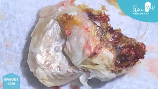 1,216 - Severe Grade III Keratosis Obturans Removal using Ear Hook