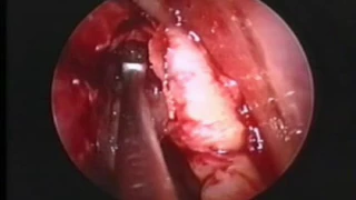 Axillary flap - frontal sinus -  Prof. P.J.Wormald