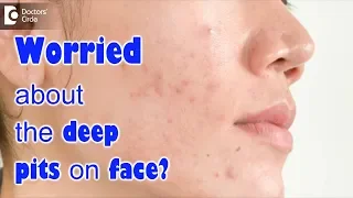 How to get rid of deep acne scars? - Dr. Udhay Sidhu | Doctors' Circle