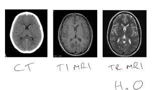 CT v MRI brain