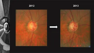 Glaucoma Grand Rounds  How Not to Crack Under the Pressure