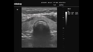 Видеозапись УЗИ - Определение размеров щитовидной железы полная методика свободной рукой