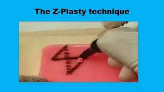 5 The Z PLASTY