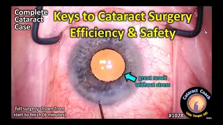 CataractCoach 1028: complete cataract case: keys to efficiency