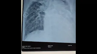 chest xray of post TB sequelae