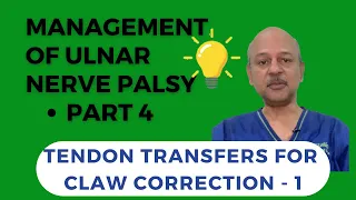 Management of ulnar nerve palsy: Tendon transfers - Part 1: Claw correction procedures