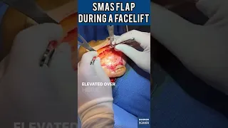 SMAS flap being elevated during Dr. Madnani’s Facelift procedure.