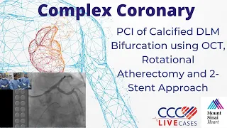 PCI of Calcified DLM Bifurcation using OCT, Rotational Atherectomy & 2-Stent Approach Jan 2015 Video