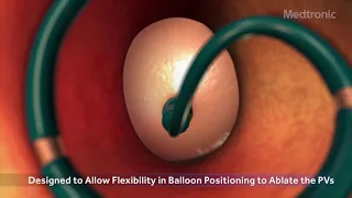 Medtronic Arctic Front Advance Cryoballoon and Achieve Advance Procedure Animation