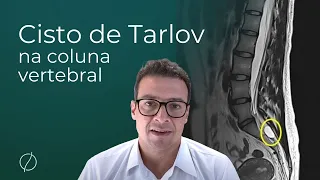 Cisto de Tarlov na coluna vertebral | cisto perirradicular - Médico especialista de coluna explica