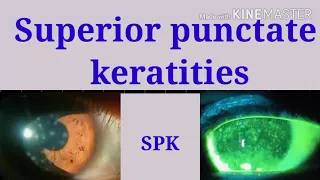superficial punctate keratitis treatment | Superficial punctate keratitis grading | SPK | herpes zos