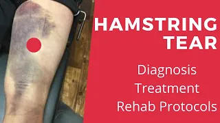 Hamstring Tear (Full Rehab Protocol by Doctor)