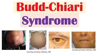 “Liver Disease From Blood Clot” (Budd-Chiari Syndrome) Risk Factors, Symptoms, Diagnosis, Treatment