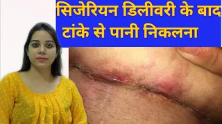 सिजेरियन डिलीवरी के बाद टांके से water discharge क्यों होता है? Drainage from Cesarean Scar.