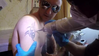 Лазерное удаление татуировки обзор))))))