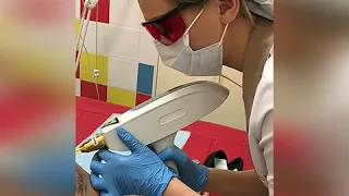 Лазерное удаление тату в клинике "АсМедия"