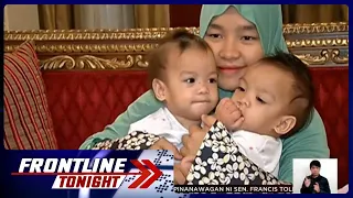 Conjoined twins sa Davao del Norte, napili ng Saudi Arabia para sa libreng operasyon