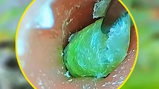 Fully Blocked Impacted Ear Wax & Dead Skin Extracted