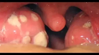 tonsil stones removal throat, how remove tonsil stones,tonsil