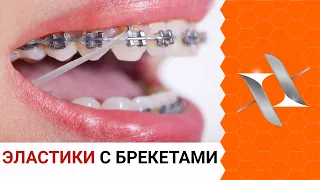 ELASTICS and braces | For what reason? How to live with them?