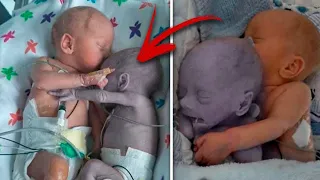 Mom puts the baby to the dying Twin and five minutes later a real Miracle happens