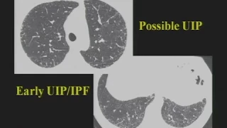 HRCT of Diffuse Lung Disease - HD [Basic Radiology]