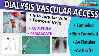VASCULAR ACCESS FOR DIALYSIS-(IJV,FEMORAL,PERMACATH & AVFISTULA)