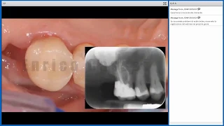 Il sigillo endodontico e il sigillo coronale