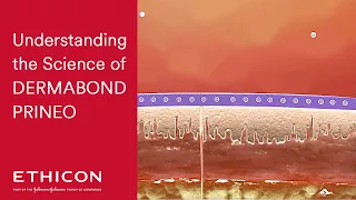 Understanding the Science of DERMABOND PRINEO | Ethicon