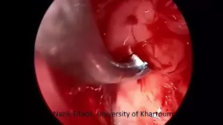 Endoscopic Management of Orbital Blow-out Fracture